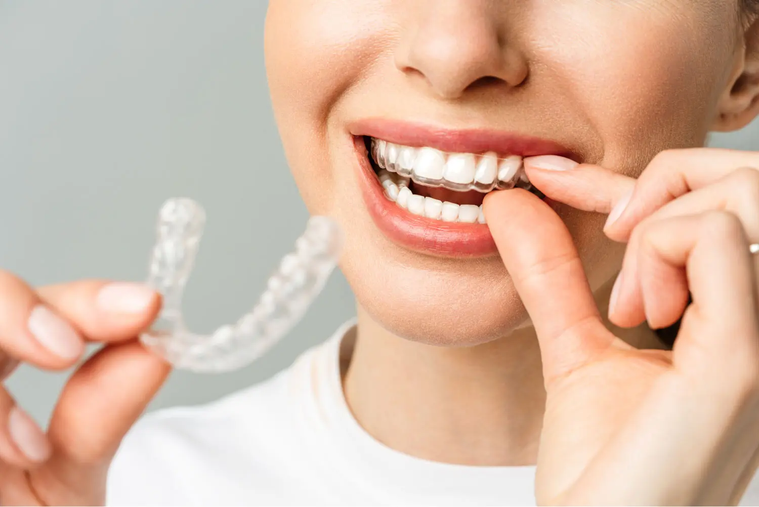 Smiling Woman Fitting Dental Mouth Guard