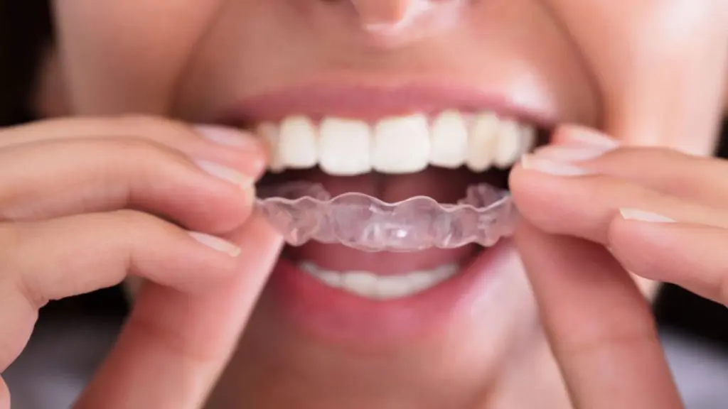 Invisalign Clear Aligners: How They Work